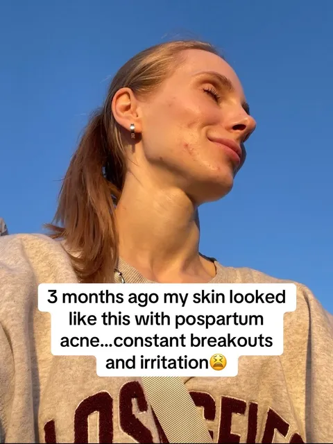 TikTok slideshow cover: Postpartum acne journey