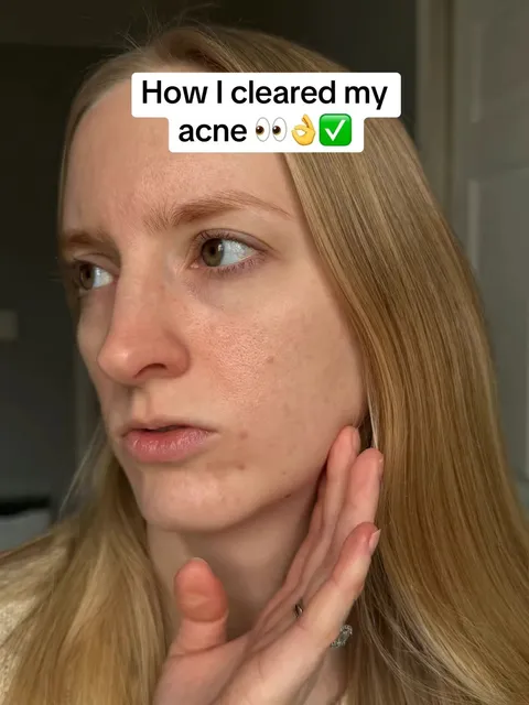 TikTok slideshow cover: Acne Clearing Journey